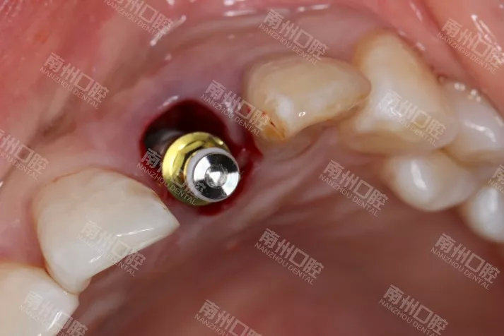 門牙折斷,種植牙修復案例分享