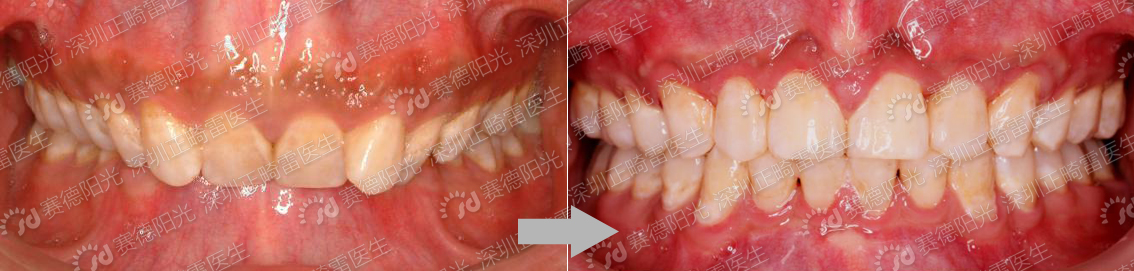 有一种毁容叫露龈笑.-雷菲菲主治医师-爱问医生