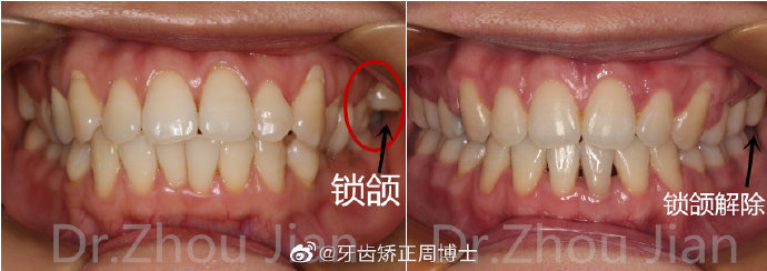 什么是锁合锁合如何解除