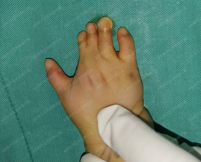 宝宝波兰综合征短指伴并指什么时候做手术比较合适