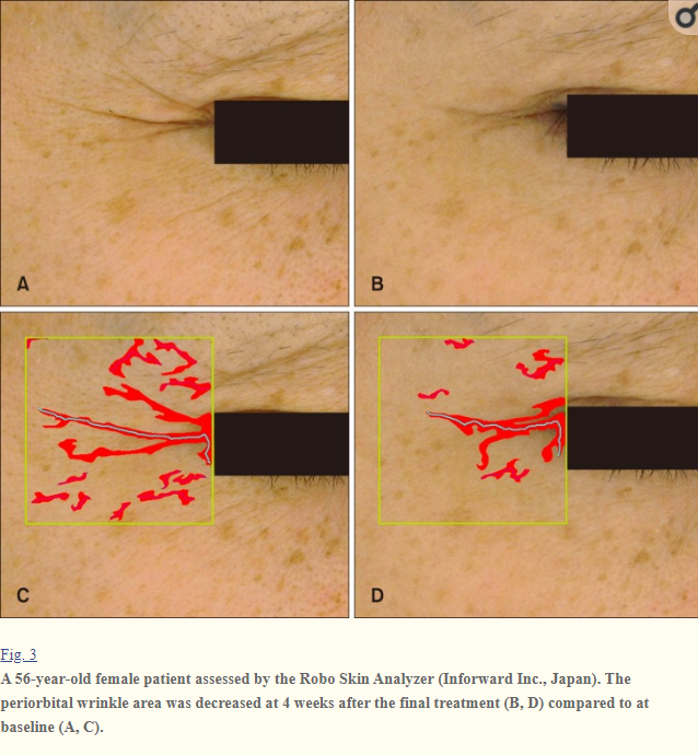 据说黄金微针射频有平价热玛吉美誉,真的吗?