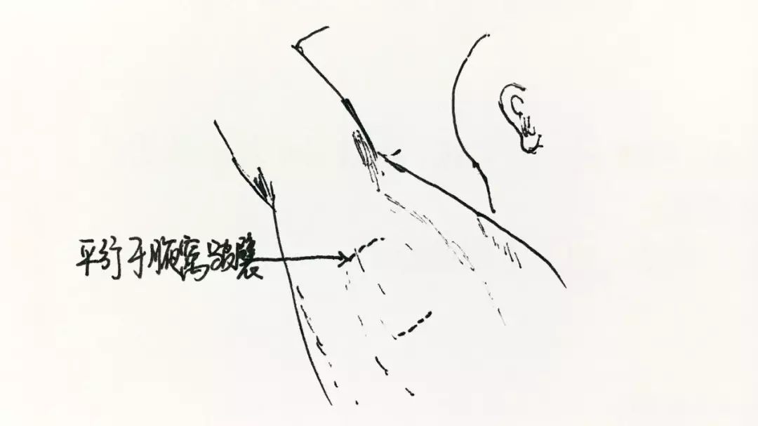 同时兼顾美观度,让切口越隐蔽越好(腋窝皱襞内小切口,使用减张缝合