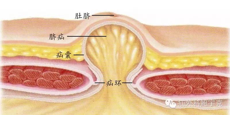 疝氣患者假日必備技能