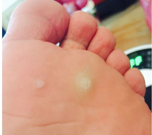 脚上长瘊子如何破