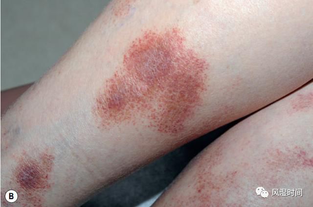 参考 1)(湿疹样紫癜,红斑,明显瘙痒,参考 3)(5)单侧线状毛细血管炎