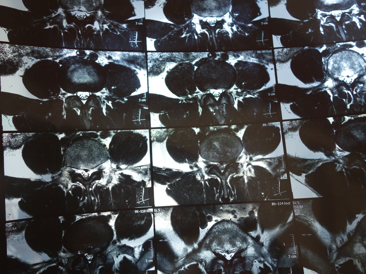 患者很痛苦,济南董瑞星,患中央型腰间盘突出,久治不愈,无奈加qq群