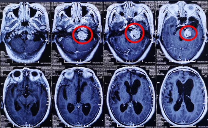 为65岁患者手术切除巨大听神经瘤