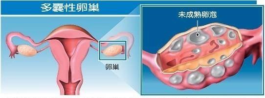 醫生,我沒有生育要求,多囊卵巢綜合徵還需要治療嗎?