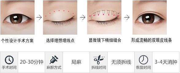 埋线三点定位和全切双眼皮的区别