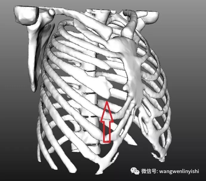 第3,4肋软骨缺失,第4肋骨残余端分叉,下方前突.图1,术前的胸壁.