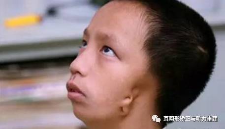 耳畸形会引发面部缺陷,我们该怎么办?