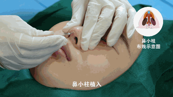 线雕隆鼻让你的鼻子挺翘颜值变高