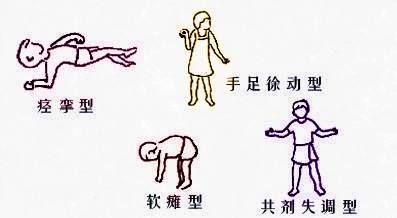 3岁和10岁的脑瘫手术效果相同吗