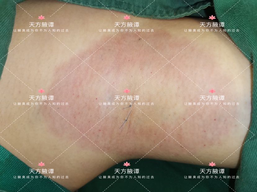 微創腋臭手術能根治腋臭嗎一千零一腋之589