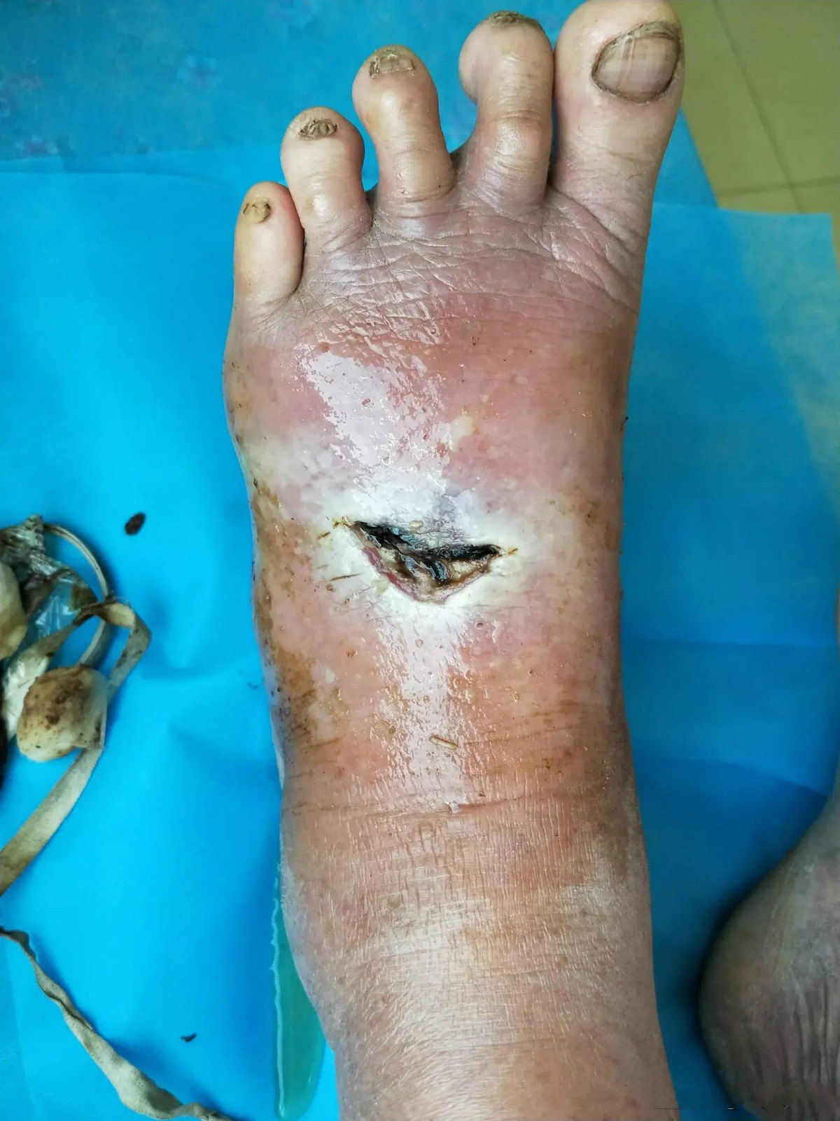 慢慢换药吧,不知道猴年马月能好····老爷子破伤风也没打,补打一针