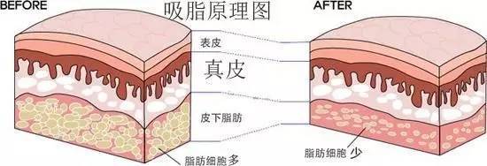 吸脂手術是利用器械通過皮膚小切口伸入皮下脂肪層將脂肪碎塊吸吃以