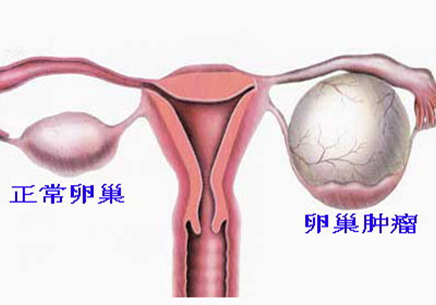 卵巢囊肿的位置图片图片
