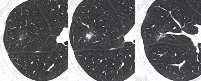 提示肿瘤的征象:结节形态趋圆球形或表现为月牙征;结节边界清楚,规则