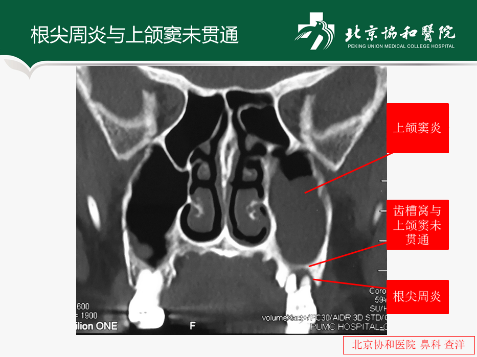 牙源性鼻竇炎如何治療