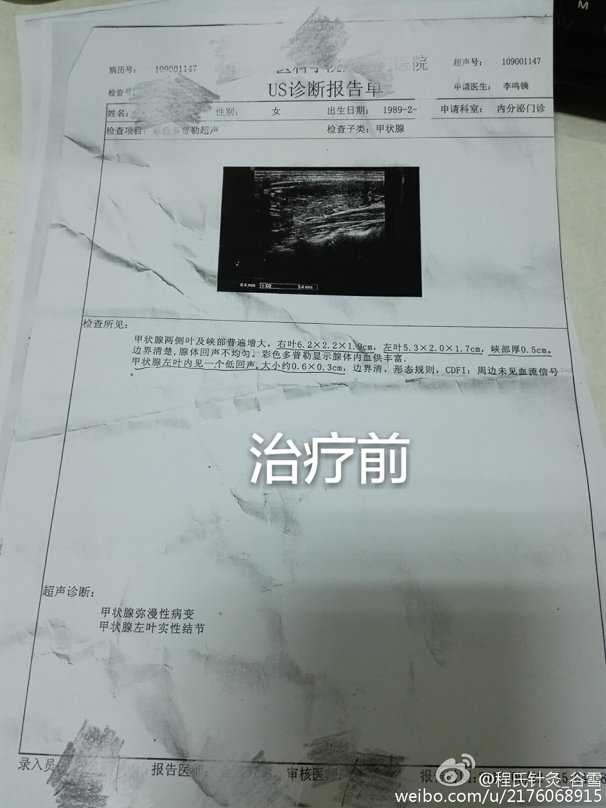 三才針法化瘀散結消甲狀腺結節與乳腺增生