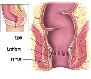 什么叫肛瘘直肠周围脓肿溃破的后遗症
