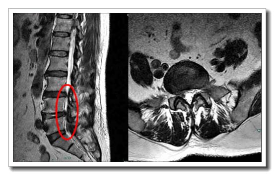 病例椎間孔鏡技術治癒腰45腰5骶1椎間盤突出症