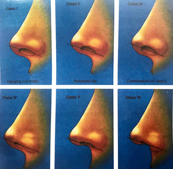 矫正方式:缩短造成鼻小柱悬垂的软骨组织(成因不同,需看相应鼻部ct片