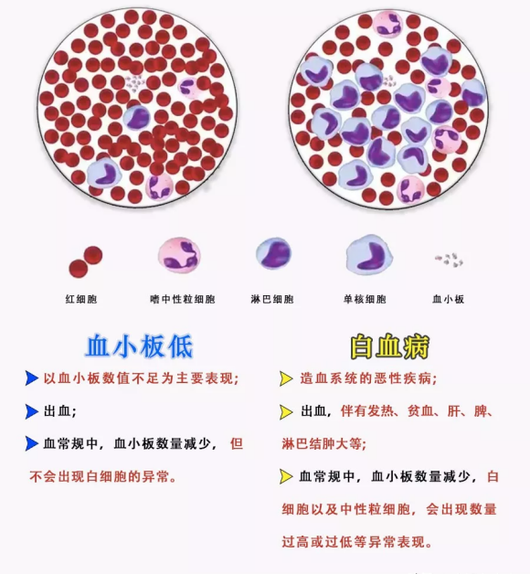 谢别录:治疗血小板减少症怎么样能治好