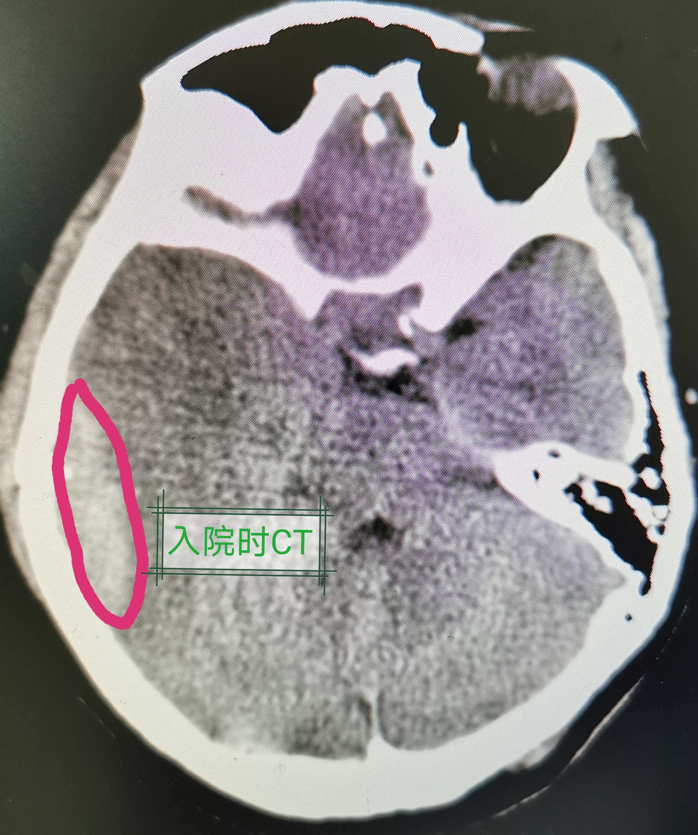 顳骨骨折需警惕硬膜外血腫