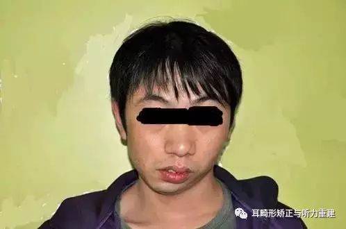 耳畸形会引发面部缺陷,我们该怎么办?