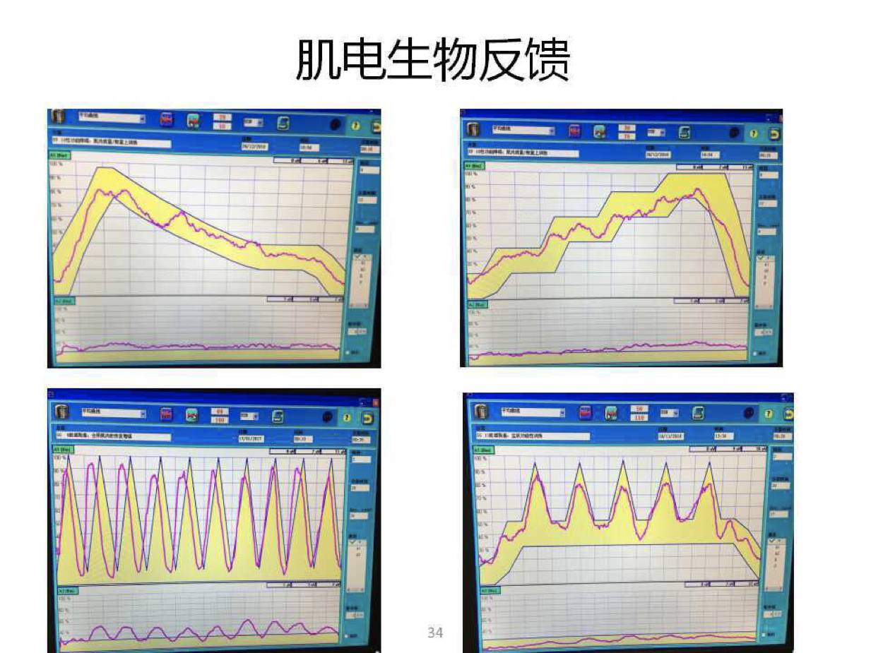 肌电生物反馈法应用于盆底肌力提升效果确切,它的原理是将肌电活动,腹