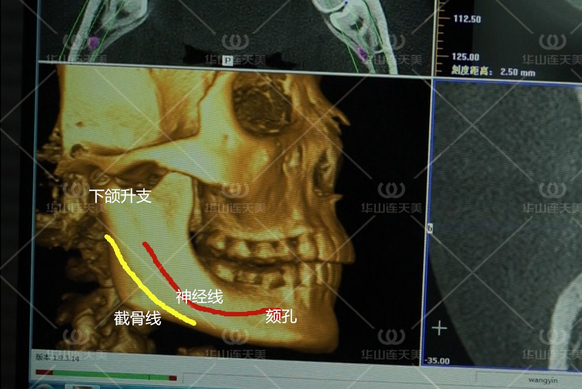 什么样的下颌角适合留角截骨?