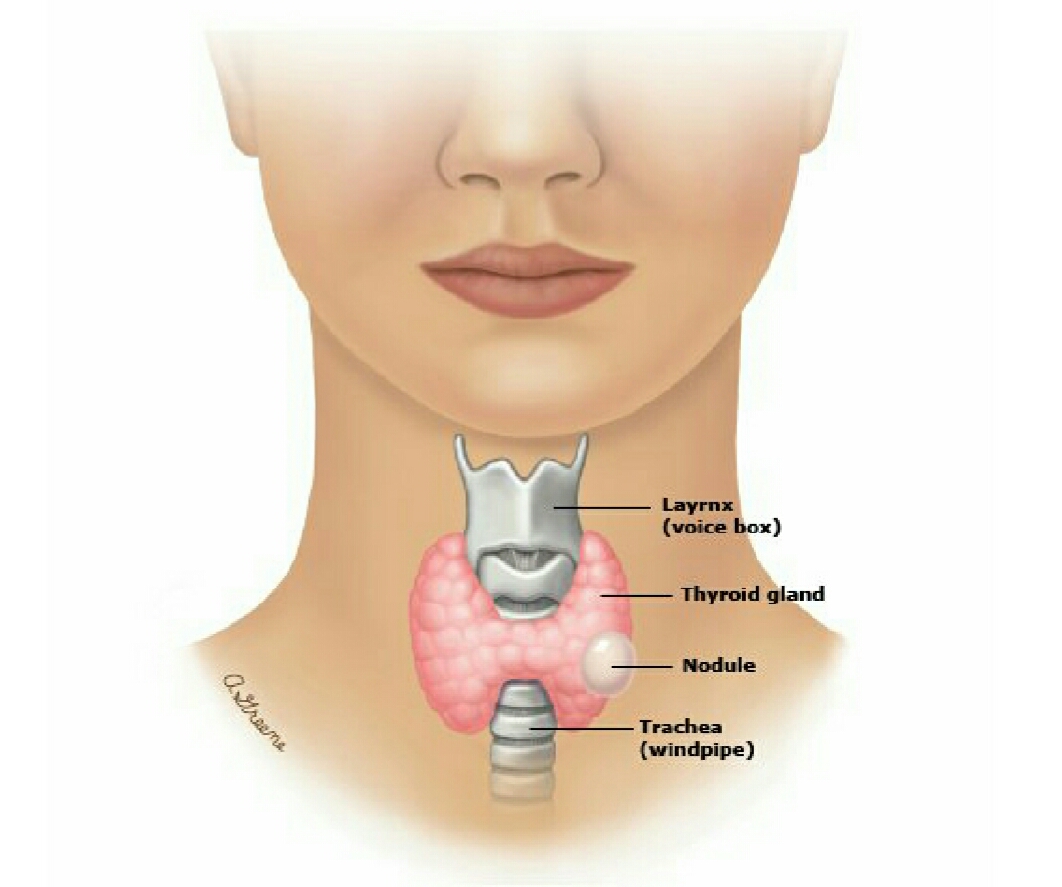 甲状腺结节图片位置图片