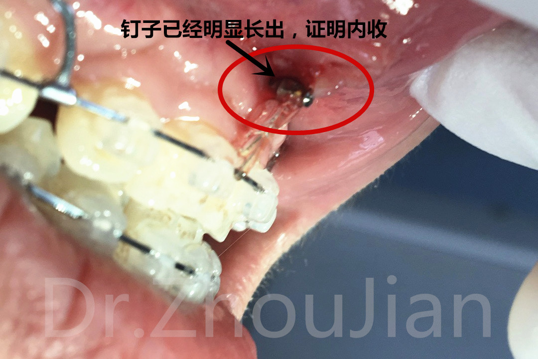 矫正牙齿非打骨钉不可吗?