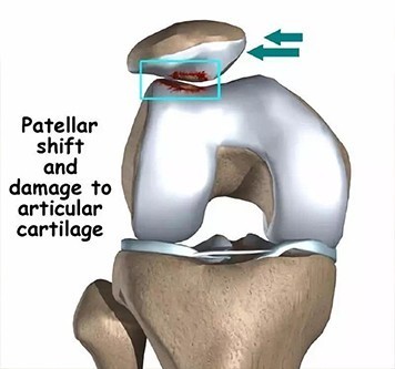 当心习惯性髌骨脱位惹得祸