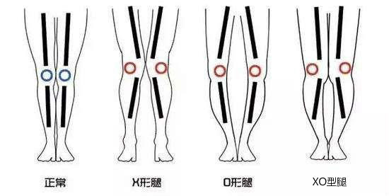 xo酒你听过xo腿你听说过吗说不定你也是xo腿哦