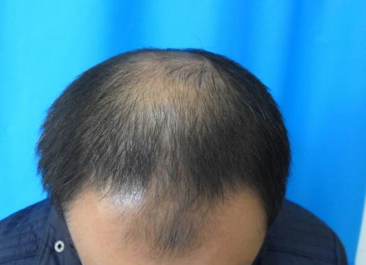 脂溢性脱发有什么症状?如何快速生发?