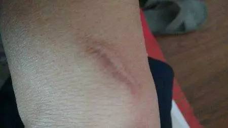 陈年老疤还可以修复吗?