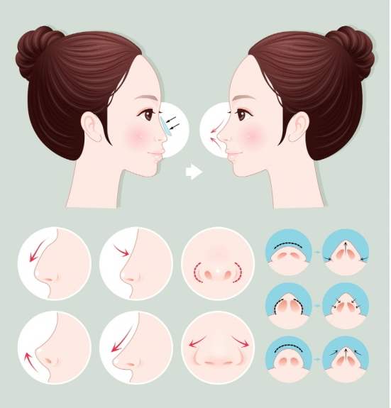 为什么做鼻子重点在于"鼻尖"的塑形?