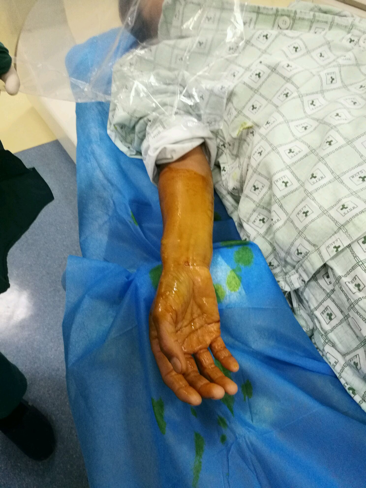 "医生视角"的冠脉造影(实录)