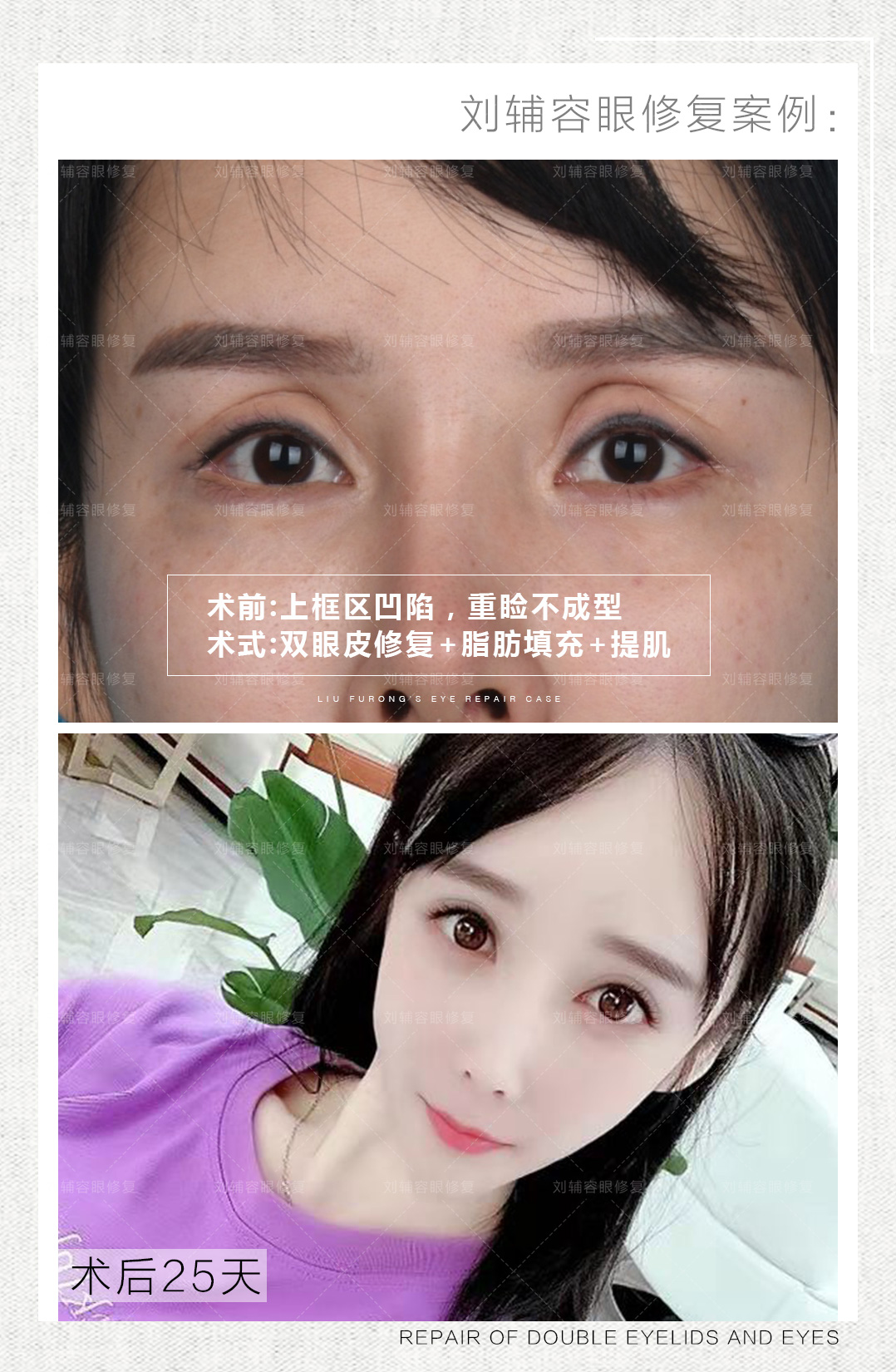 如果有眼袋 上睑凹陷,可以用眼袋的脂肪来填充上眼睑的凹陷.
