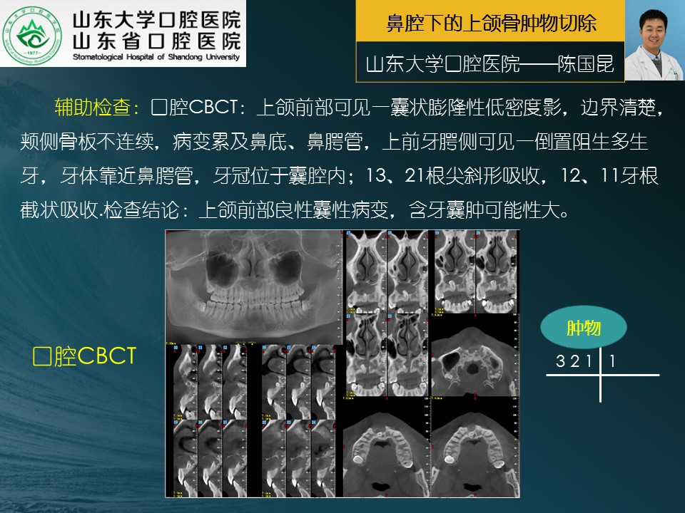 頜面外科手術系列1鼻腔下的上頜骨腫物