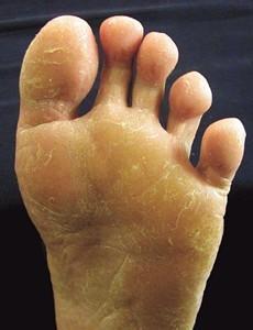 最长情的病之一脚气香港脚