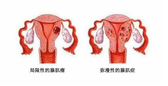 子宫腺肌病也被称为内在型子宫内膜异位症,是子宫内膜腺体和间质