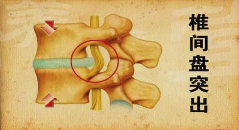 幫你瞭解腰椎間盤突出症