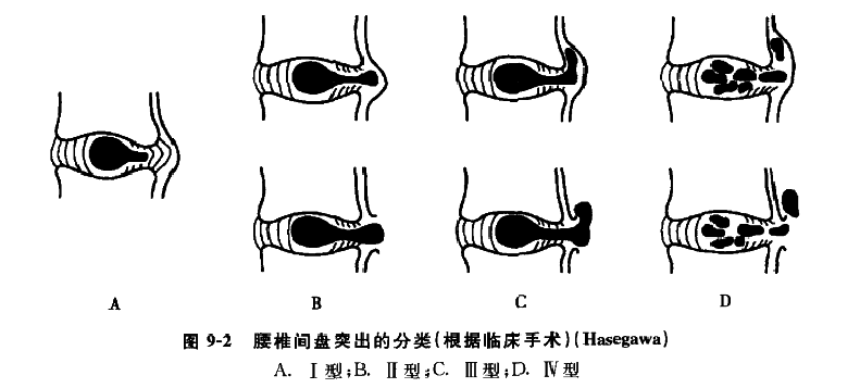 腰椎间盘膨出突出脱出游离