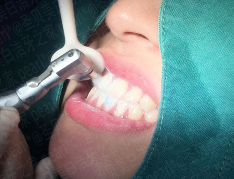 使用进口抛光膏对牙齿进行抛光使牙齿表面更加光滑细菌不易附着