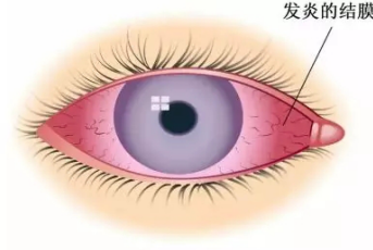 结膜炎的分类及常见症状