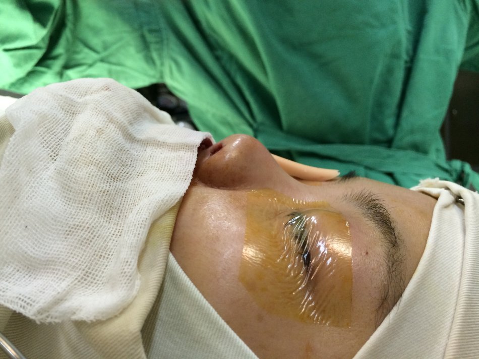 入路(鼻小柱无疤痕)全自体肋软骨修复硅胶隆鼻——刘波隆鼻--爱问医生