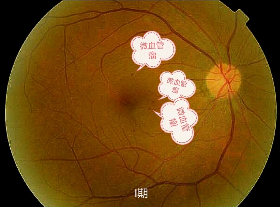 糖尿病视网膜病变的眼底变化